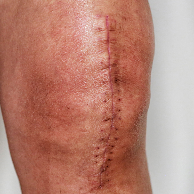 Knee Replacement