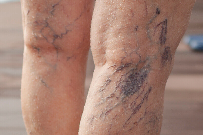 Close-up of branching spider veins on skin