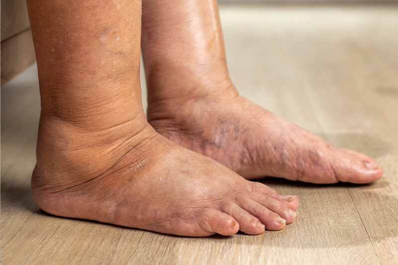 A person resting swollen, heavy legs at the end of the day