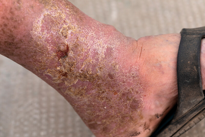 A venous leg ulcer on the inner ankle, the open sore that untreated vein disease can lead to