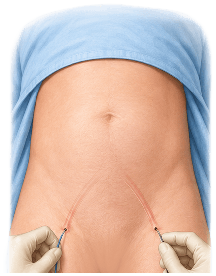 Two tiny groin incisions