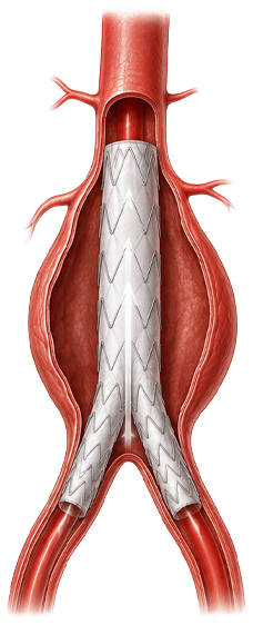 Illustration of an endovascular stent graft deployed inside an abdominal aortic aneurysm