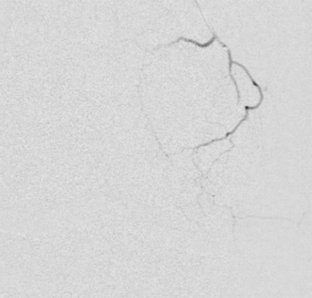 Knee angiogram after GAE, That excess blood flow reduced, and the pain with it