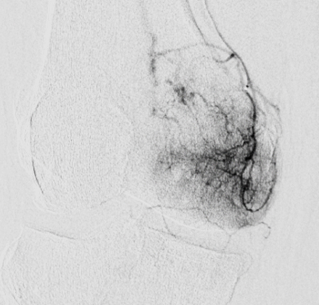 Knee angiogram before GAE, A dense tangle of abnormal vessels feeding the joint