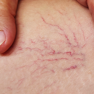 Sclerotherapy
