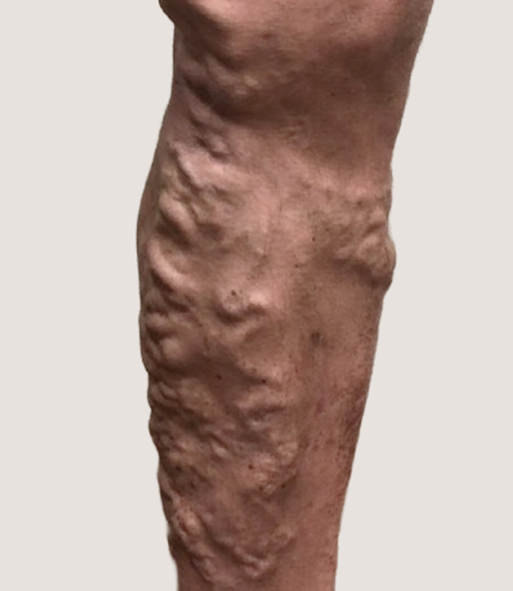 Vein disease stage 2: Visible veins