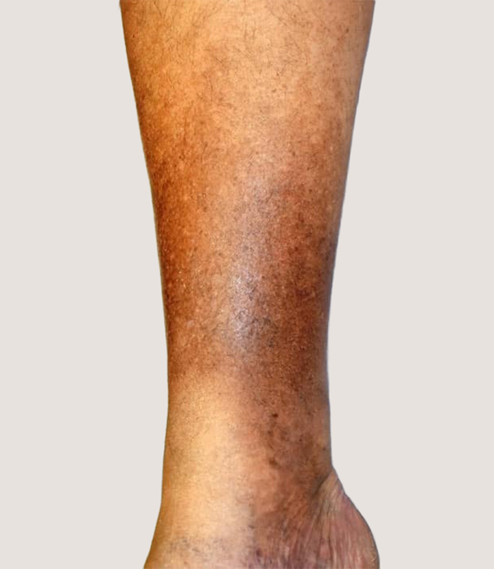 Vein disease stage 3: Skin changes