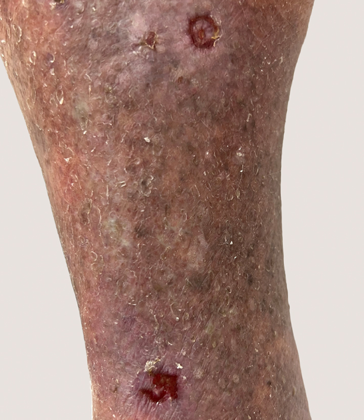 Vein disease stage 4: Wounds & ulcers
