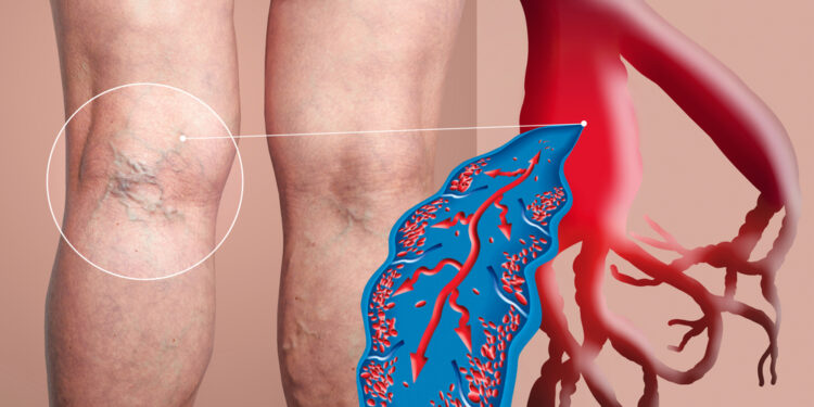 Close-up of legs with deep vein thrombosis and medical illustration showing affected veins.
