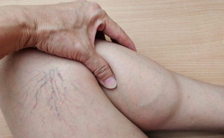 A person touching their leg that has spider veins.