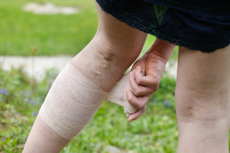 A woman wrapping tape around a leg with varicose veins.