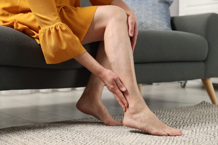 A woman sitting on a couch grabbing her leg with varicose vein pain.