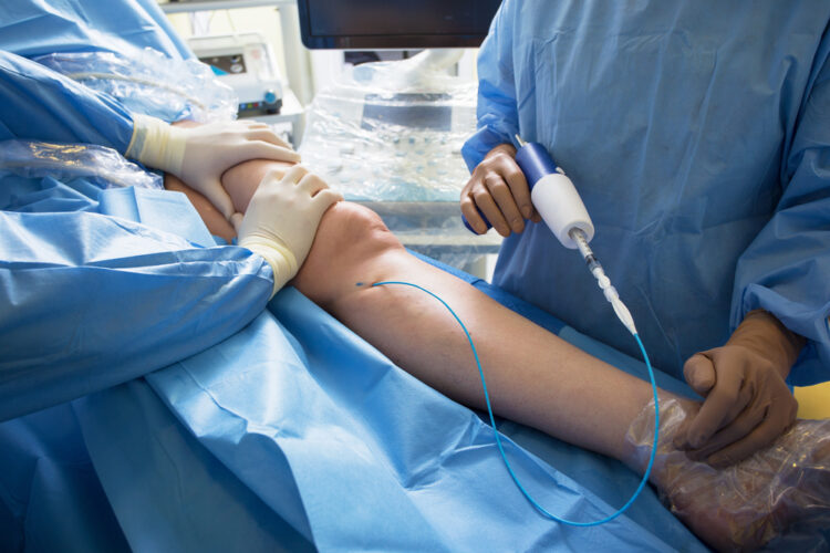 A pair of vascular surgeons performing surgery on a patient's leg with a vascular related issue.