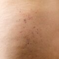 A closeup of a person's thigh with brown spots on it.