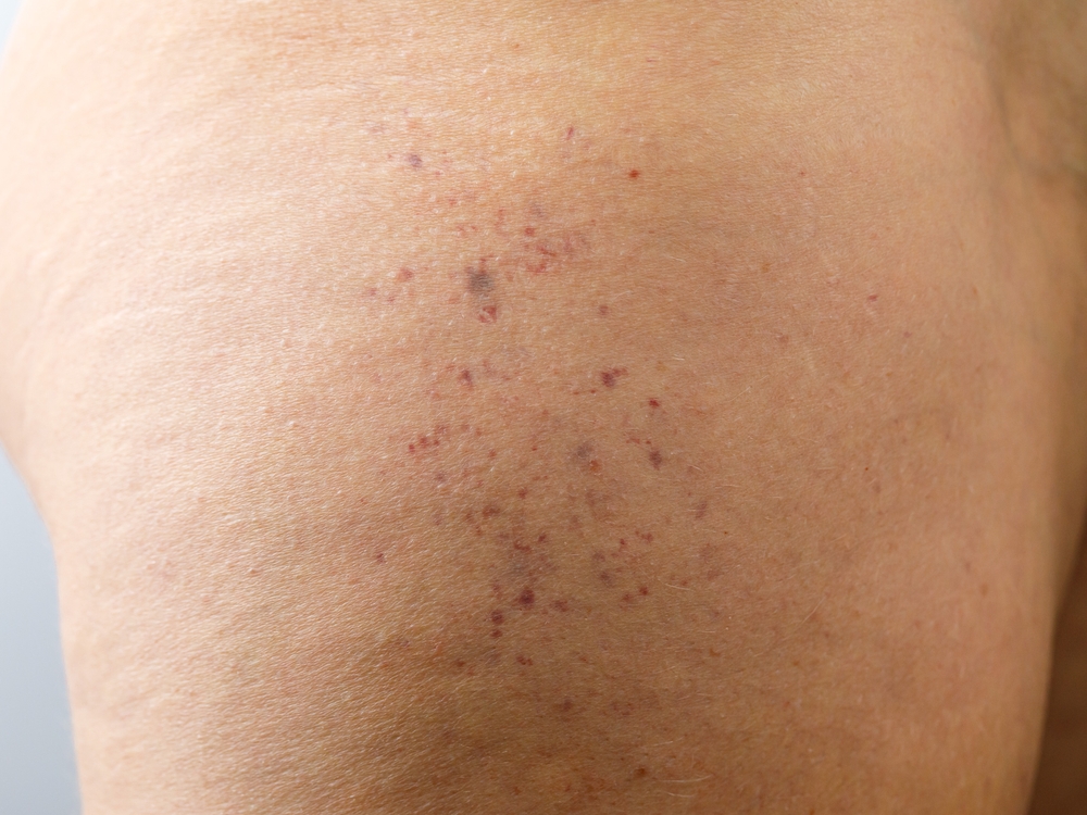 A closeup of a person's thigh with brown spots on it.